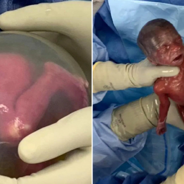 Astonishing Photos: Birth of Second Most Premature Twin Babies Ever to Survive