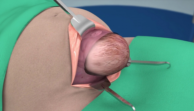 3D Animation: What Happens During a Cesarean Delivery?