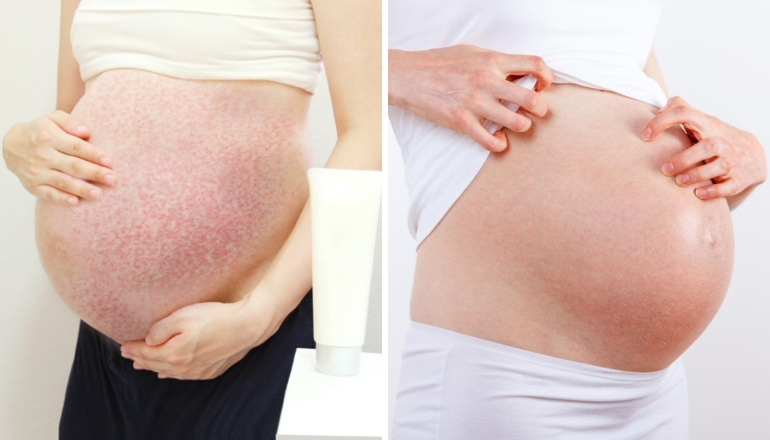 6 Annoying Pregnancy Skin Issues (And How to Deal) | Pregnant Life