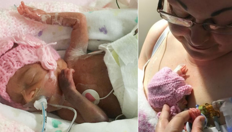 Miracle Baby Born at 24-Weeks with Feet the Size of Pennies