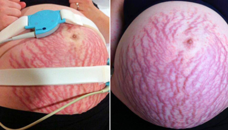 Mum Was Allergic To Her Own Baby After Erupting In Horrific Rash All ...
