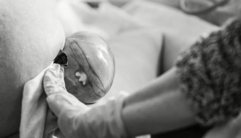 Baby Was Born in the Caul After a Powerful Labor