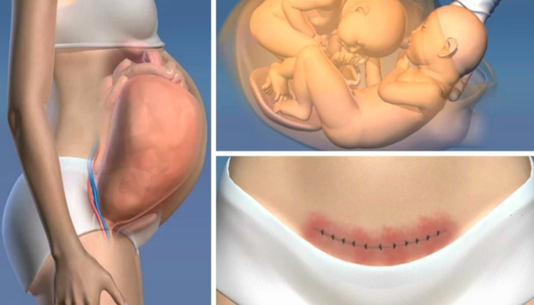 Everything You Need to Know About the Caesarean Section | Pregnant Life