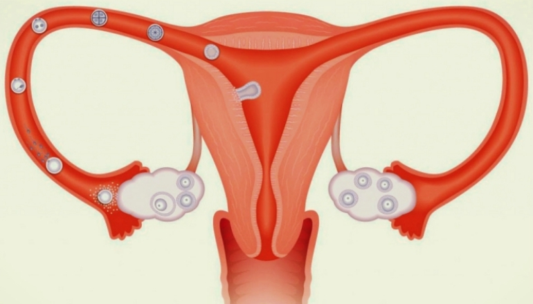 How Does Tubal Sterilization Prevent Pregnancy? | Pregnant Life