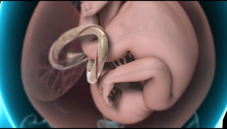 Amniocentesis (Amniotic Fluid Test)