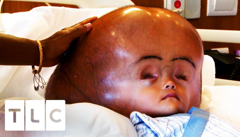 Child's Fluid-Filled Head Is 3 Times The Size It Should Be | My Baby's Head Keeps Growing