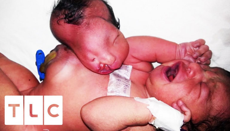 Baby Born With Two Heads Gets Vital Surgery | Body Bizarre