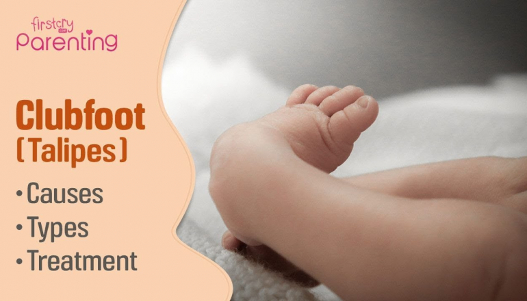 Club Foot (Talipes) in Babies - Causes, Signs & Treatment