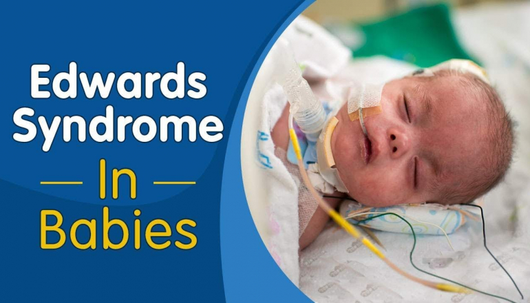Edwards Syndrome in Babies