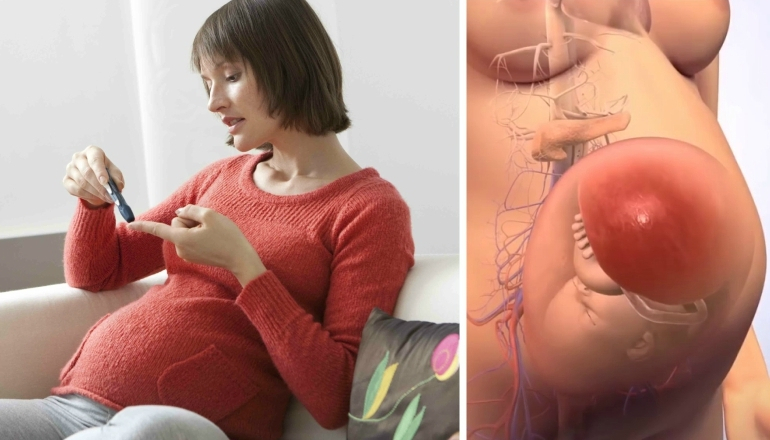 Prevention of Gestational Diabetes During Pregnancy