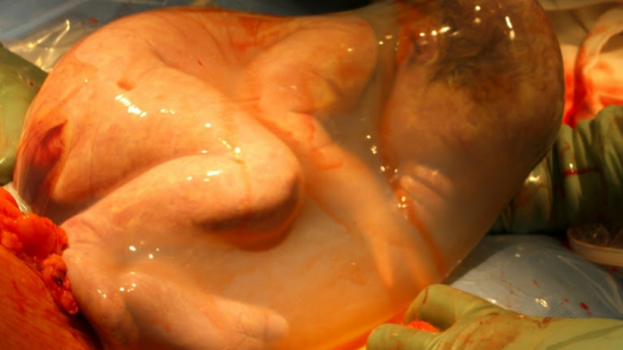 10 Extraordinary Photos of Babies Born in the Amniotic Sac