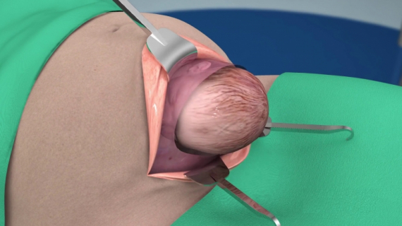 3D Animation: What Happens During a Cesarean Delivery?