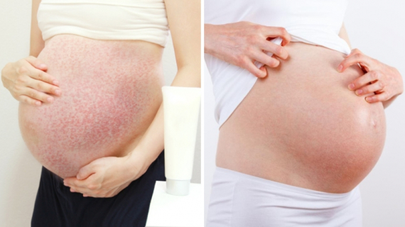 6 Annoying Pregnancy Skin Issues (And How to Deal)