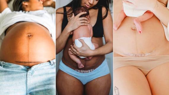 8 Tips for a Fast C-Section Recovery