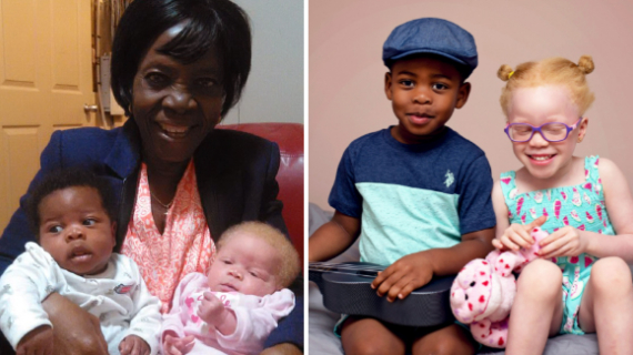 A Mom Who Gave Birth To One Black And One Albino Twin