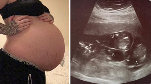 A Single Mum Falls Pregnant With Triplets While On The Pill