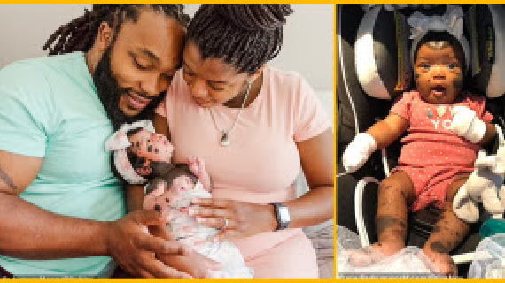 A beautiful baby girl was born with a unique condition that has caused dark spots all over her body.