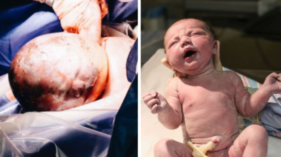 "All The Nurses Were Pointing": Stunned Dad Captures The Remarkable Moment His Baby Girl Was Born Inside Amniotic Sac