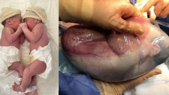 Astonishing Moment Twin Is Born Still Inside Amniotic Sac In One-In-80,000 Event