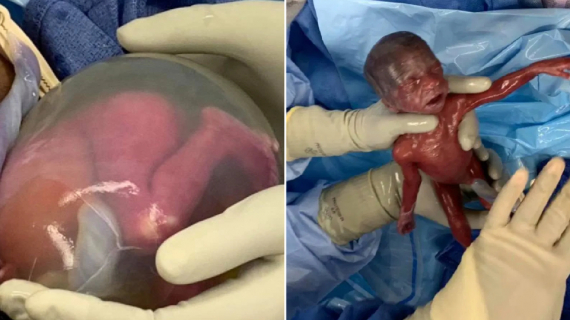 Astonishing Photos: Birth of Second Most Premature Twin Babies Ever to Survive Astonishing Photos: Birth of Second Most Premature Twin Babies Ever to Survive