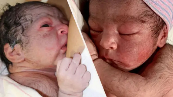 Baby Born With Beard And Extra Body Hair Dubbed ‘Mini Wolverine’ By Father