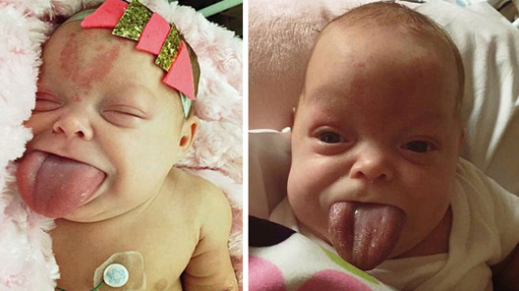 Baby Girl Born With Adult Sized Tongue Can Finally Smile After Life-Saving Op To Stop Her Choking On It