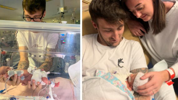 Baby Was Born Three Months Prematurely And Weighing  Just 2lb 2oz Was Saved By Her Parent’s Kangaroo Cuddles