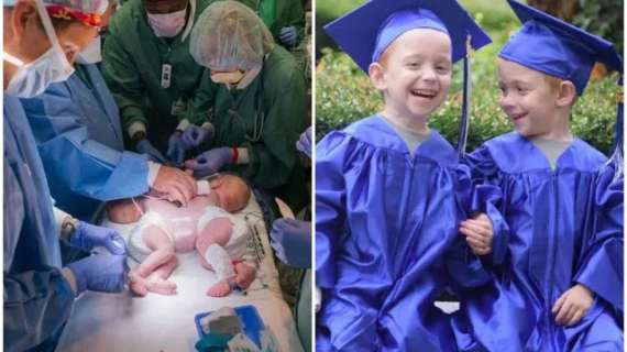 Doctors Said Conjoined Twins Wouldn’t Survive But They Just Graduated From Kindergarten.