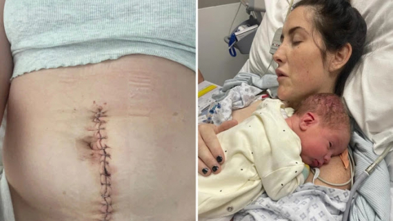 Doctors Said I Was a Hypochondriac After I Suffered Stomach Pains – But During Caesarean They Found Out I Had Cancer
