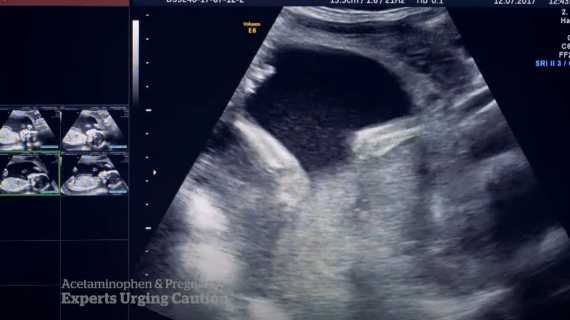 Experts urge caution about overusing acetaminophen during pregnancy