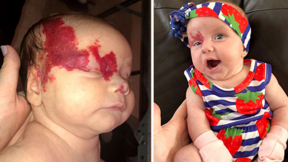 Facebook Stranger Spots Newborn’s ‘Tiny Birthmark’ That Spread Across Her Face Like Dripping Blood Is Rare Tumour