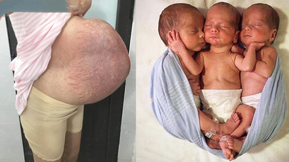 Girl Had Triplets At 16