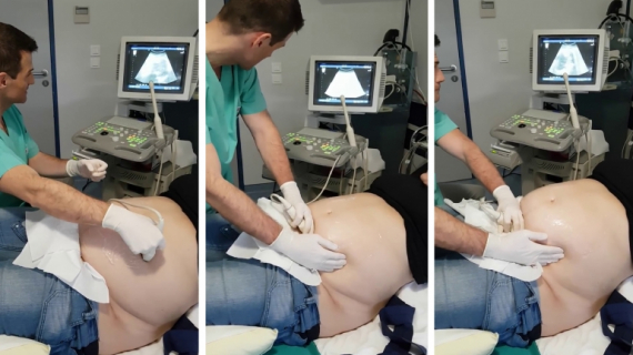 How External Cephalic Version (ECV) is Done?