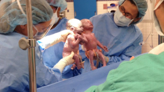 Inseparable Twins Born Holding Hands Moments After Birth
