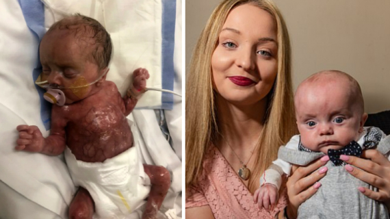 Miracle Baby Born With No Skin And 30 Weeks Premature Defies All Odds To Survive