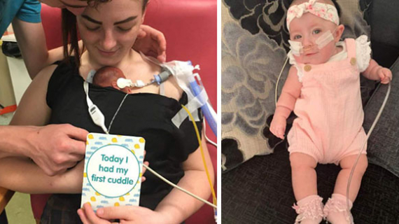 Miracle Baby Weighing Just 1lb 2oz At Birth Defies All Odds As She Celebrates Her First Birthday This Week