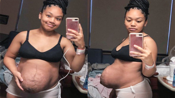 Mom Shares What Her Body Looks Like Hours After Birth & It’s Postpartum Perfection
