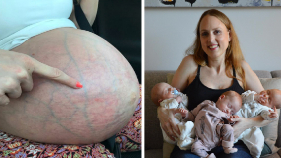 Mother Of Triplets Shows Huge Baby Bump A Month After Giving Birth