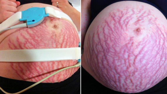Mum Was Allergic To Her Own Baby After Erupting In Horrific Rash All Over Her Body Month Before Birth