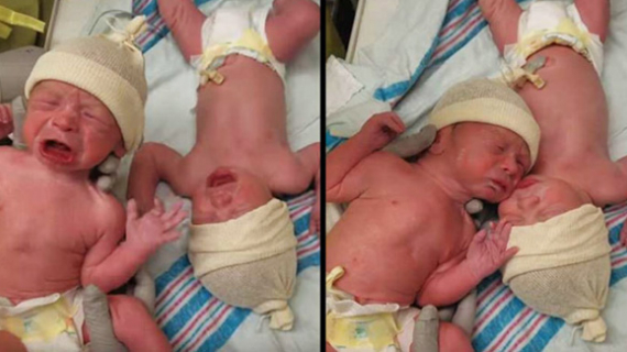 Newborn Twin Boys Wᴏɴ’t Stop Crying Unless They’re Touching