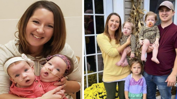 One-Year-Old Conjoined Twins Successfully Separated In 11-Hour Surgery