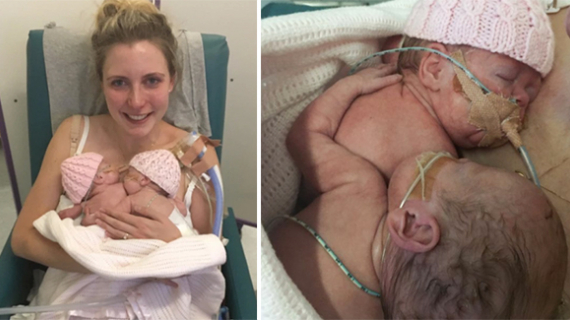 Premature Baby’s ‘Goodbye Hug’For Her Dying Twin Sister