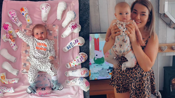 Smiling Baby Born With Clubfoot Celebrates Amazing Progress In Adorable Photo