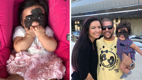 Toddler Left With 'Batman Mask' Due To Rare Skin Condition That Causes Dark Patches