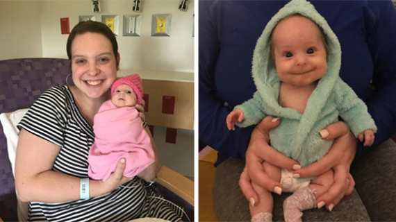 Two-Year-Old Girl, 7 lbs With Rare Form Of Dwarfism