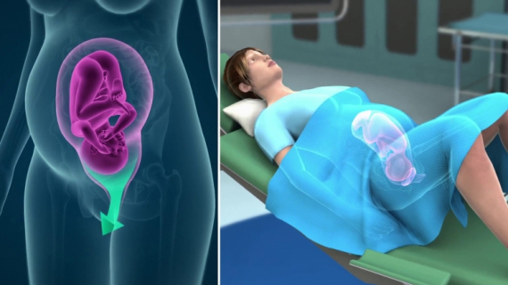 3D Animation: Process of a Vaginal Birth