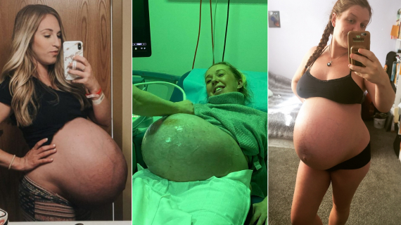 What Being Pregnant with Multiples Looks Like? What Being Pregnant with Multiples Looks Like?