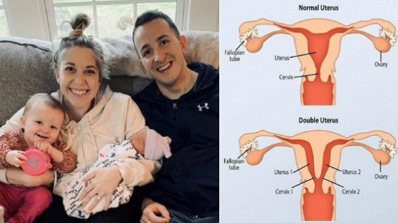 Woman, 30, With Two Uteruses Gives Birth To Two Babies In One Year