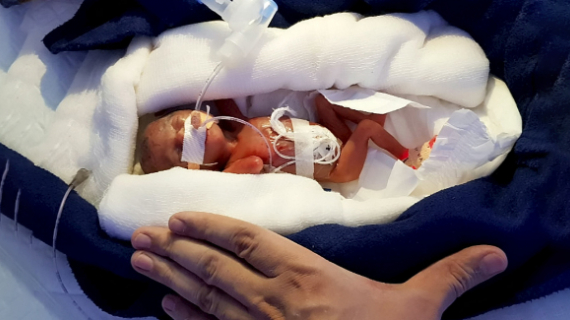 World's 'Smallest Surviving Baby' Born Weighing Only 8 Ounces And With Feet The Size Of a Fingernail