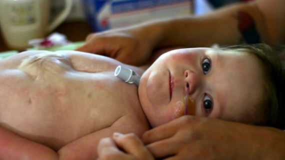 Baby Born With Heart Outside Her Chest